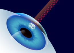 Laserabtragung bei Femto-LASIK